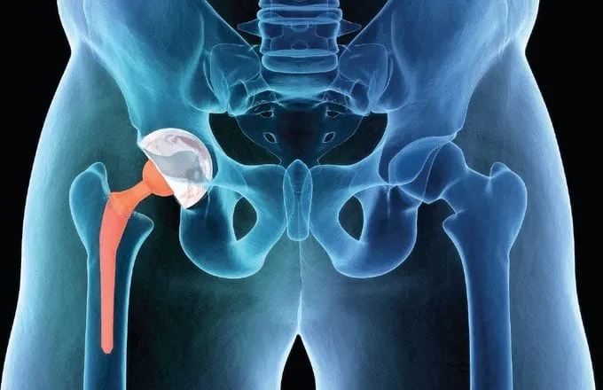 Científicos afirman que un trasplante de cadera puede durar hasta 25 años