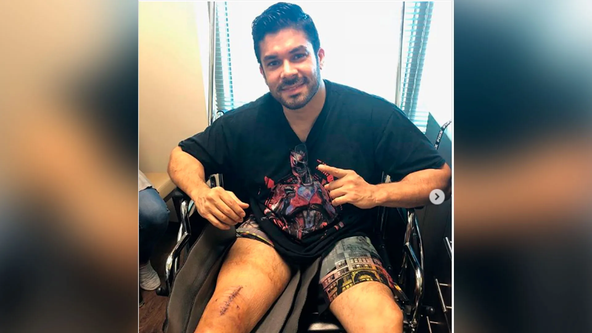 Jerry Rivera mostró la cicatriz de su pierna