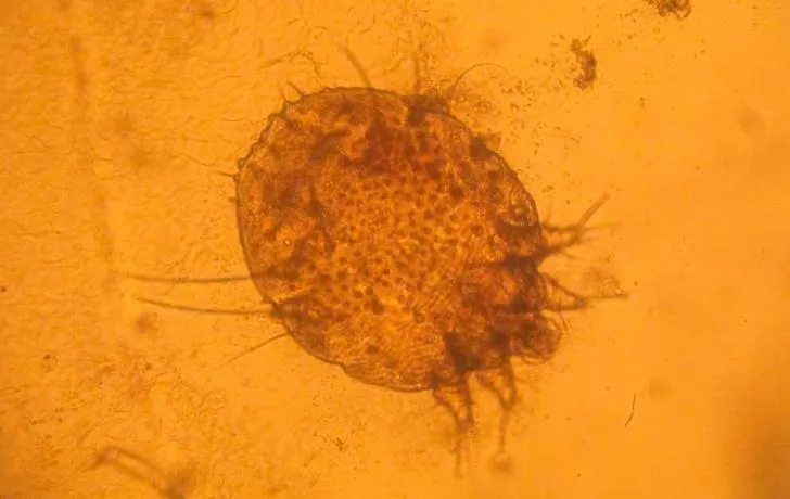 La sarna o escabiosis, una enfermedad muy antigua pero sin solución en los tiempos modernos 5 La sarna o escabiosis, una enfermedad muy antigua pero sin solución en los tiempos modernos